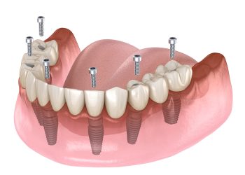 Ultimate Dental Implants Guide