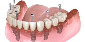 Ultimate Dental Implants Guide