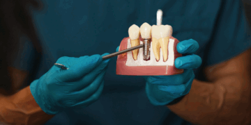 A Complete Guide to the Dental Implant Process in Rockville