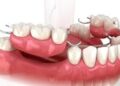 Easy Dentures: How To Make Wearing Dentures A Breeze